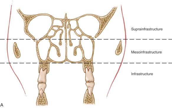 Fig. 3-1, A, Diagram of a coronal view of the sinonasal cavities. The lines divide the maxillary sinuses into three zones: suprastructure, mesostructure, and infrastructure. Tumors limited to and below the mesostructure usually can be resected by a partial or total maxillectomy without an orbital exenteration. Tumors involving the suprastructure may need an orbital exenteration to reduce the chance of tumor recurrence. B, Diagram of the lateral view of a skull with the Ohngren line drawn. Tumors anterior to this line tend to have a better prognosis.