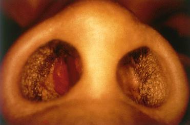 Fig. 3-11, Intranasal lobular capillary hemangioma characterized by a smooth lobulated, polypoid red mass.