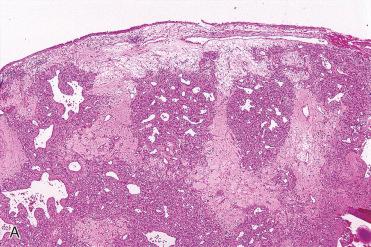 Fig. 3-12, Intranasal lobular capillary hemangioma.