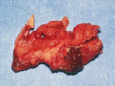 Fig. 3-13, Sinonasal hemangiopericytoma-like tumor.