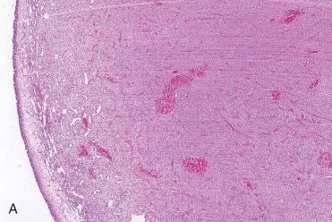 Fig. 3-14, Sinonasal hemangiopericytoma-like tumor.