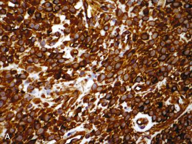 Fig. 3-15, Immunohistochemical staining in sinonasal-type hemangiopericytoma.