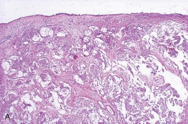 Fig. 3-16, Sinonasal meningioma.