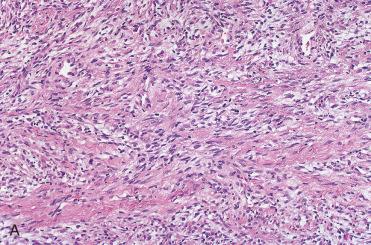 Fig. 3-18, Sinonasal solitary fibrous tumor.