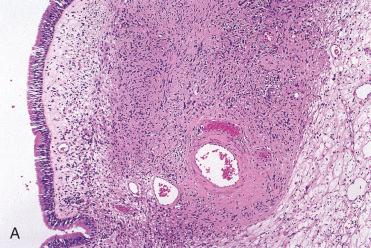 Fig. 3-19, Sinonasal benign peripheral nerve sheath tumor (benign schwannoma).