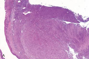 Fig. 3-20, Sinonasal benign fibrous histiocytoma.