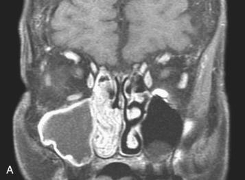 Fig. 3-2, Schneiderian papilloma, inverted type.