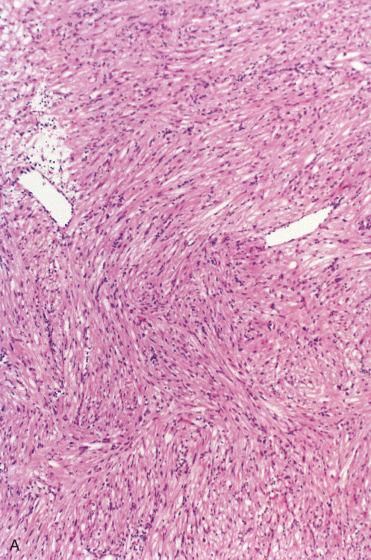 Fig. 3-22, Sinonasal leiomyoma.