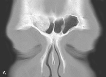 Fig. 3-23, Sinonasal osteoma.