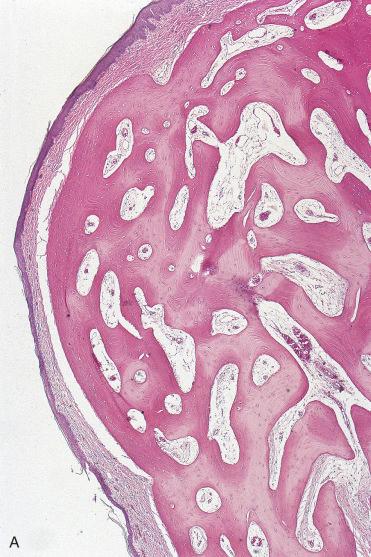 Fig. 3-24, Sinonasal osteoma.