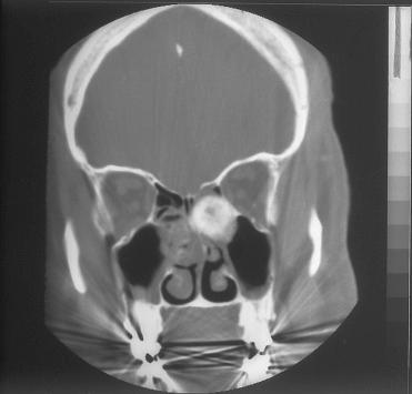 Fig. 3-25, Axial CT of psammomatoid active ossifying fibroma (PAOF) demonstrating an inhomogeneous, radiodense mass in the left ethmoid and maxillary sinuses causing bowing outward of the medial wall of the left orbit and displacement but not destruction of the nasal septum.