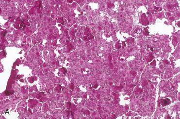 Fig. 3-26, Psammomatoid active ossifying fibroma.