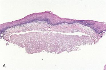 Fig. 3-27, Nasal septal chondroma.