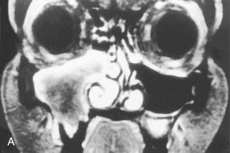 Fig. 3-28, Sinonasal fibromyxoma.