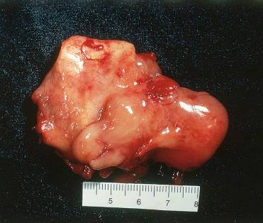 Fig. 3-29, Sinonasal fibromyxoma.