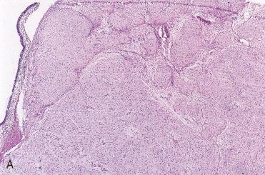 Fig. 3-30, Sinonasal fibromyxoma.