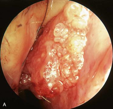 Fig. 3-3, Schneiderian papilloma, inverted type.