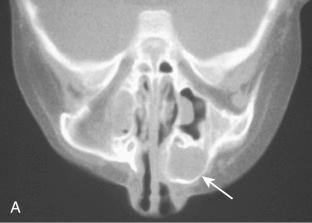 Fig. 3-31, Sinonasal myxoma.