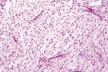 Fig. 3-32, Sinonasal myxoma with predominant myxoid stroma and a relatively hypocellular spindle-shaped cellular proliferation. A nondescript (compressed) identifiable vascular component is present, lacking the delicate plexiform capillary network often seen in association with various (myxoid) sarcomas.