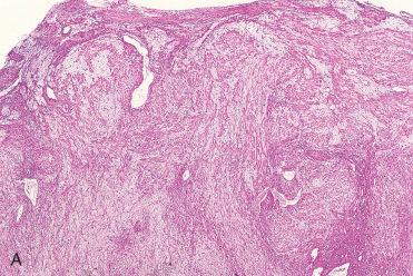 Fig. 3-33, Chondromyxoid fibroma is characterized by ( A ) lobular appearance with lobules separated by vascularized connective tissue; the lobules demonstrate a zonal arrangement of the cellular component, with the center of the lobules being predominantly composed of a chondromyxoid matrix with scattered stellate-appearing cells and the periphery of the lobules being more cellular. B, Cellular components of the chondromyxoid fibroma include cells with round to oval to spindle-shaped nuclei, an eosinophilic to amphophilic cytoplasm often with multipolar, stellate extensions set in a chondroid to mucinous-appearing matrix.