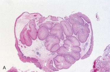 Fig. 3-4, Schneiderian papilloma, inverted type.