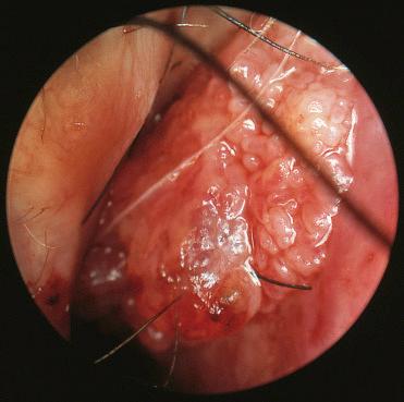 Fig. 3-5, Schneiderian papilloma, exophytic (septal) type.