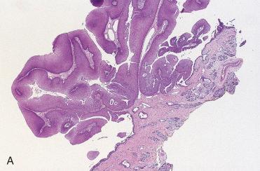 Fig. 3-6, Schneiderian papilloma, exophytic (septal) type.