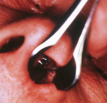Fig. 3-7, Schneiderian papilloma, oncocytic type appearing as an intranasal dark red to brown mass.