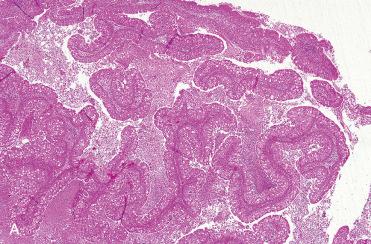 Fig. 3-8, Schneiderian papilloma, oncocytic type.