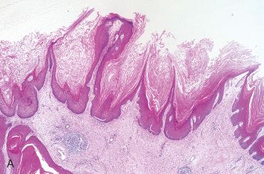 Fig. 3-9, Schneiderian papilloma, inverted type.