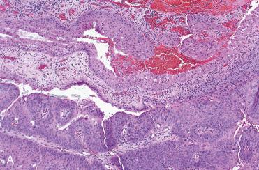 Fig. 3-10, Schneiderian papilloma, oncocytic type may also undergo malignant transformation.