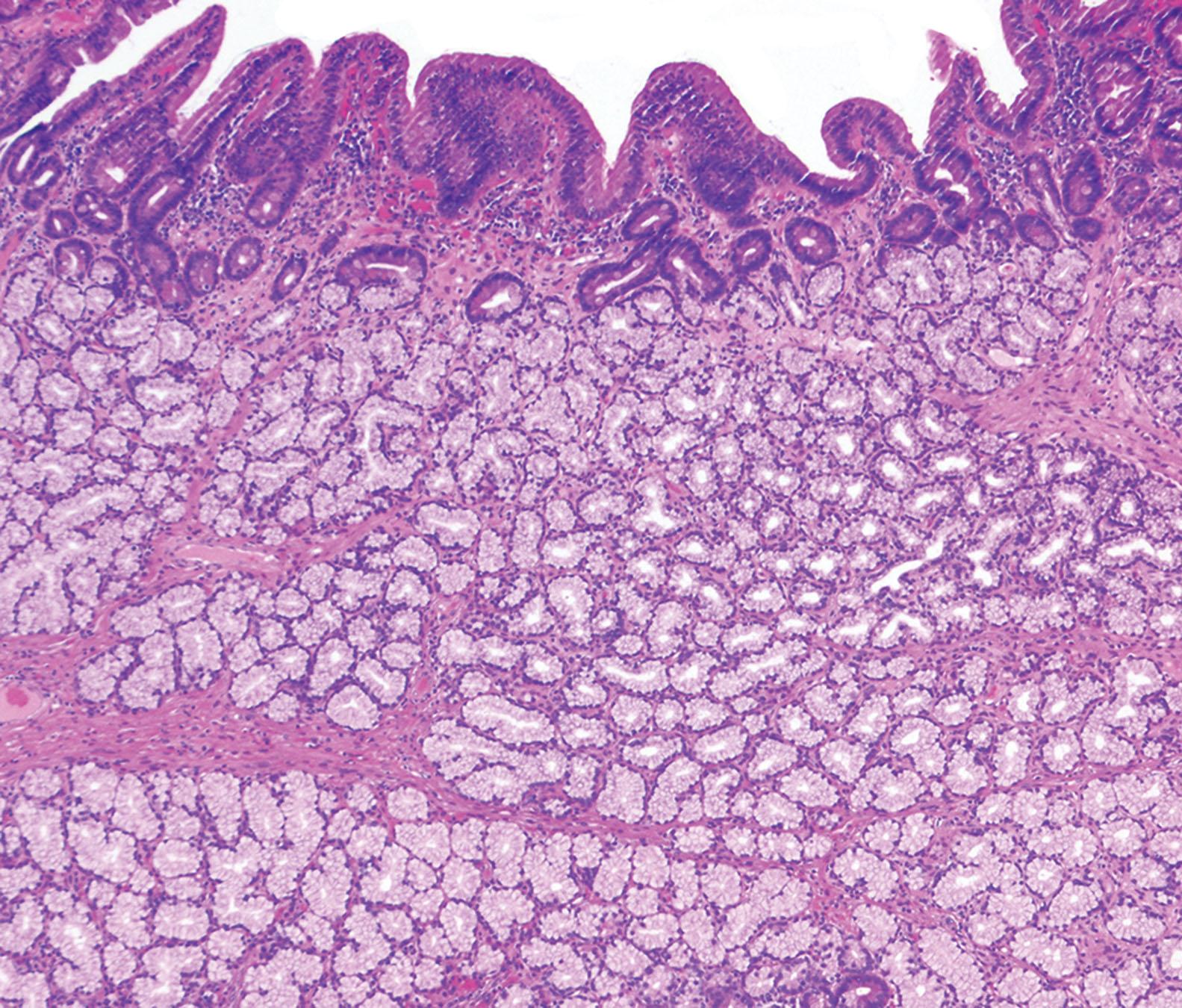Figure 6.1, Brunner’s gland hyperplasia: The lesion is characterized by prominent lobules of Brunner’s glands within the submucosa and lamina propria.