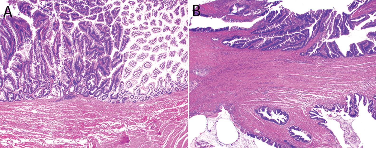 Figure 6.11, This patient had mucosal colonization of a segment of ileum that resembled a villous adenoma of the small intestine with a sharp transition from normal to overtly neoplastic epithelium ( A ). This patient had a known history of a primary appendiceal mucinous adenocarcinoma with evidence of disseminated peritoneal disease, numerous serosal tumor deposits, and one area of transmural invasion into the bowel wall ( B ), arguing against a primary small intestinal adenocarcinoma.