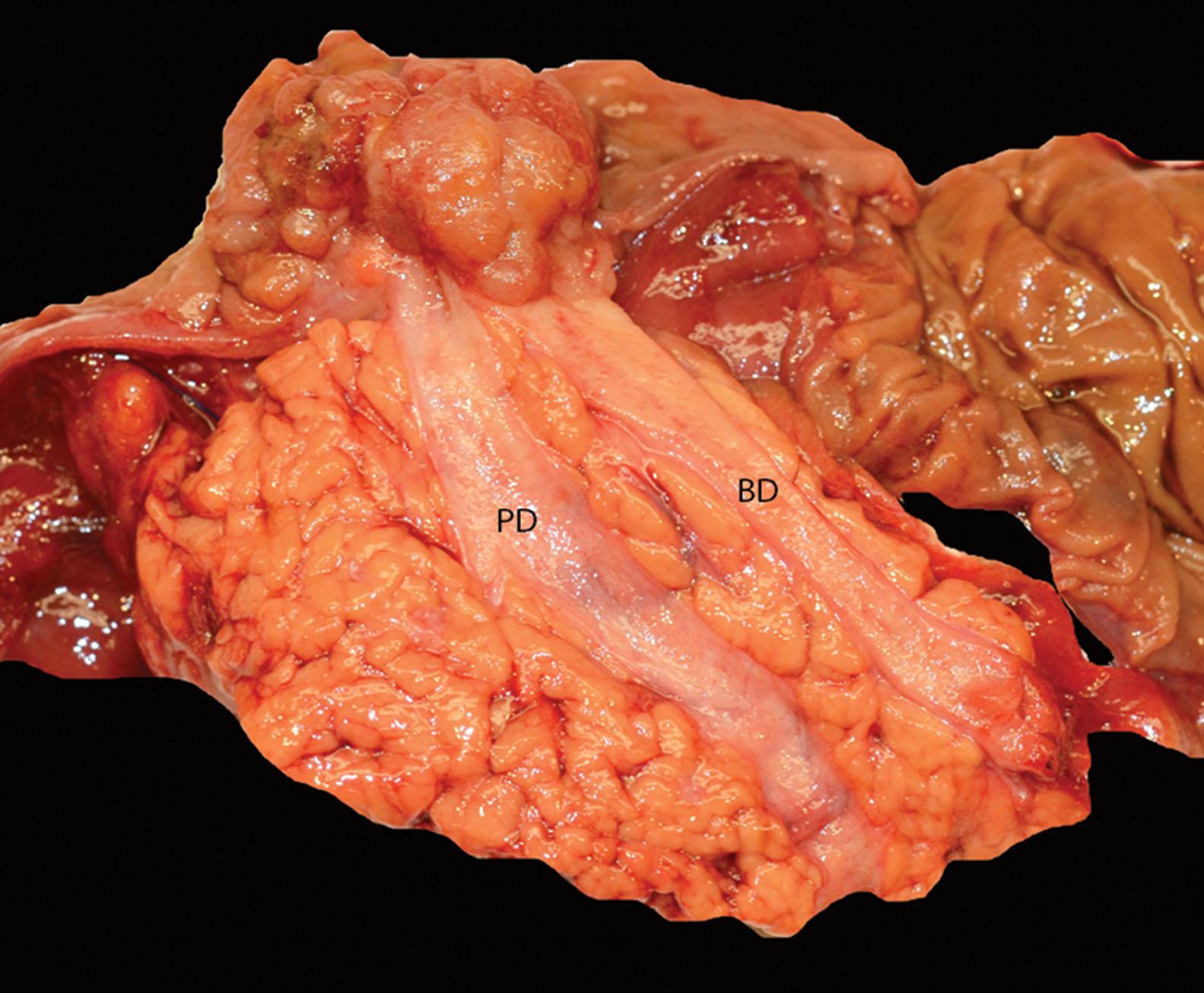 Figure 6.13, Gross appearance of an ampullary adenocarcinoma, periampullary duodenal type with tumor surrounding the papilla of Vater with prominent polypoid involvement of the duodenal surface of the papilla. Both the pancreatic duct (PD) and common bile duct (BD) are dilated.