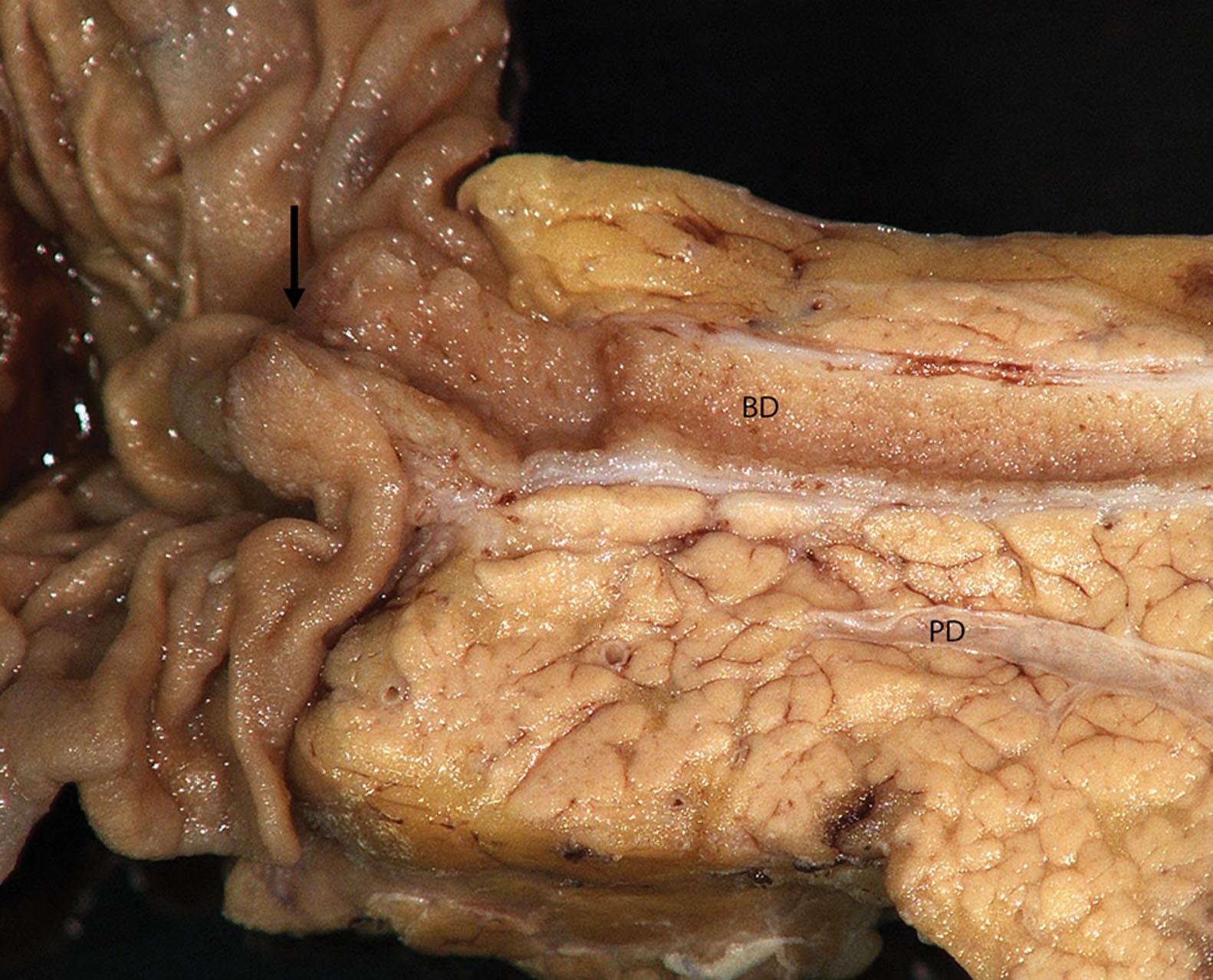Figure 6.14, Gross appearance of an ampullary adenocarcinoma, not otherwise specified, with tumor centered on the papilla of Vater (black arrow) associated with a dilated common bile duct (BD) and pancreatic duct (PD).