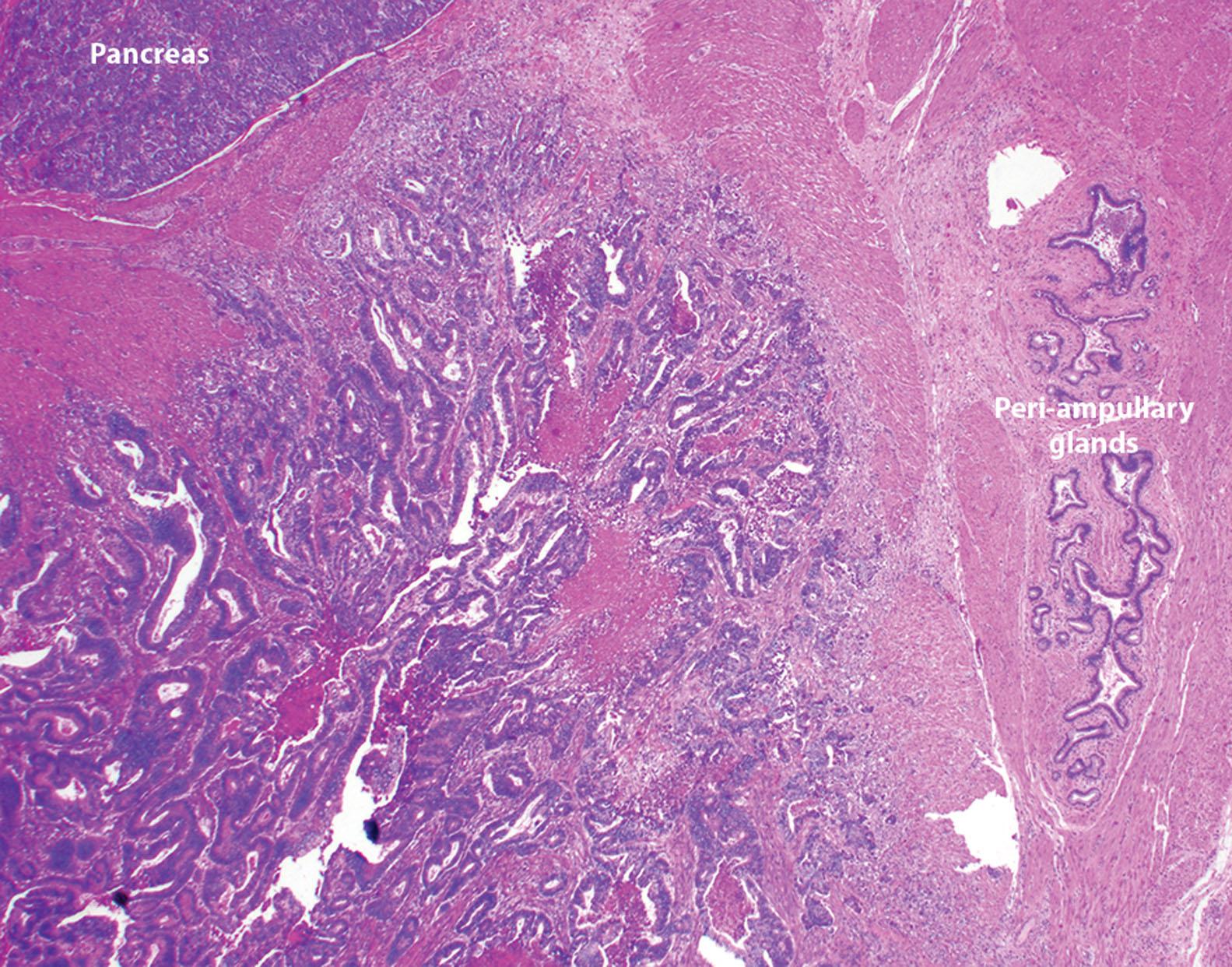 Figure 6.15, Ampullary adenocarcinoma invading through the muscle of the sphincter of Oddi, which contains periampullary glands. The invasive adenocarcinoma closely approaches adjacent pancreatic parenchyma.