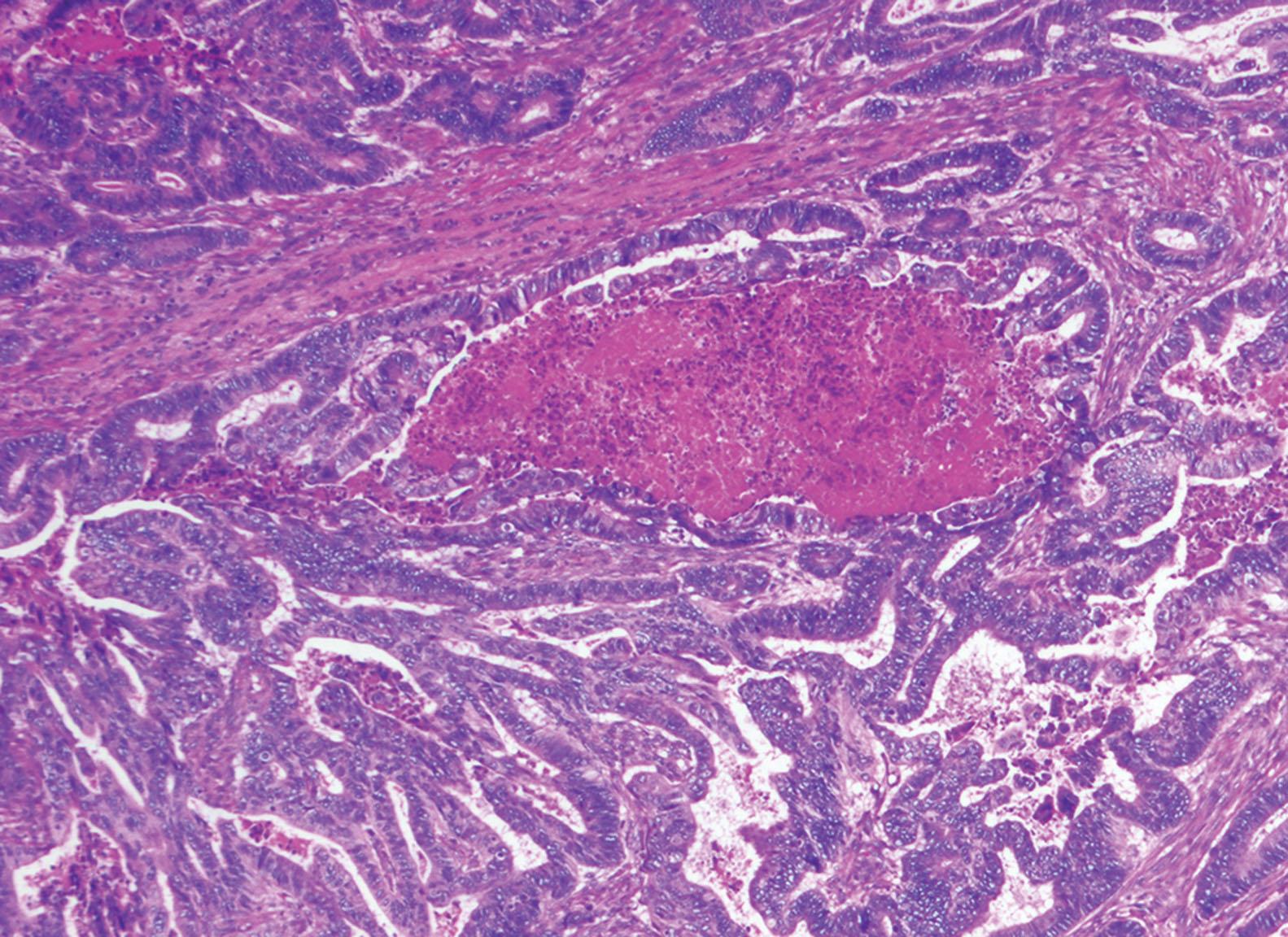 Figure 6.16, Ampullary adenocarcinoma, intestinal type, characterized by large glands lined by columnar cells with pseudostratified nuclei and associated with luminal necrosis.