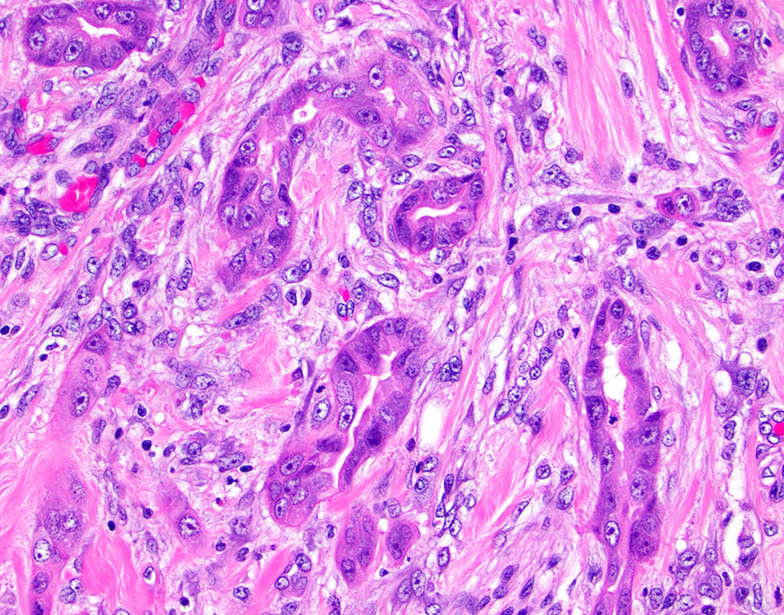Figure 6.17, Ampullary adenocarcinoma, pancreaticobiliary type, characterized by small glands lined by cuboidal eosinophilic epithelium with irregular nuclear.