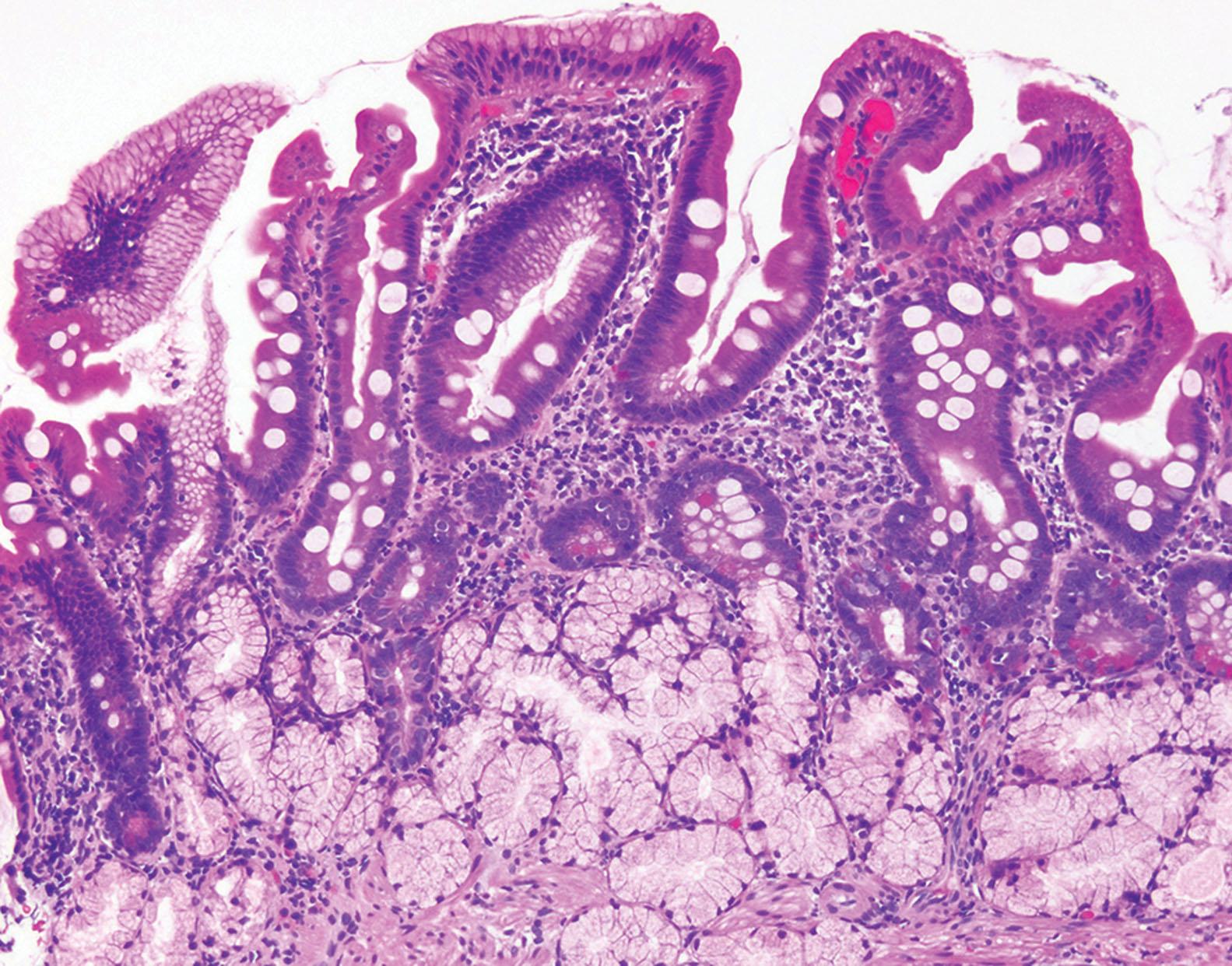 Figure 6.2, Peptic duodenitis: Prominent Brunner’s glands within the submucosa and lamina propria associated with foveolar-type metaplasia on the villous surface of the duodenum and partial villous shortening are characteristic. In contrast to the absorptive cells of the small intestine, foveolar metaplastic cells have small apical mucin vacuoles (top left).
