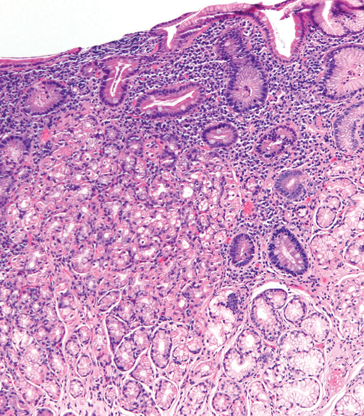 Figure 6.3, Gastric heterotopia: Tightly packed gastric oxyntic glands involving the duodenal mucosa. The surface epithelium also demonstrates gastric foveolar-type metaplasia.