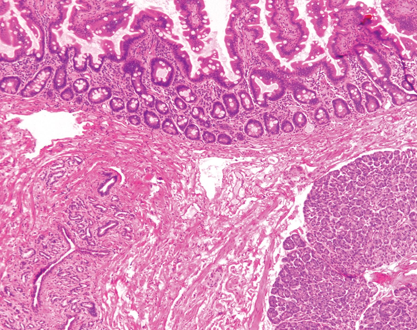 Figure 6.4, Pancreatic heterotopia: Lobules of ancreatic heterotopia consists of tightly packed pancreatic acini (bottom right) associated with pancreatic ducts (bottom left) located in the duodenum. In this image, the pancreatic heterotopia involves the duodenal submucosa, but it can involve any layer of the bowel wall.