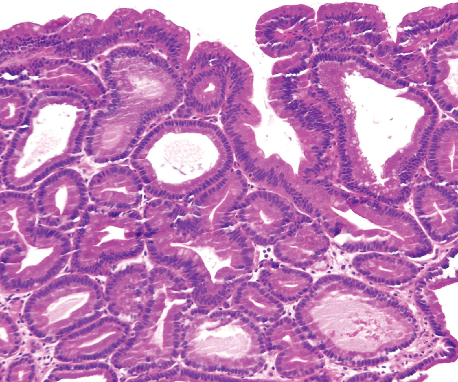Figure 6.6, Pyloric gland adenoma: Tightly packed glands lined by cuboidal epithelium with basally located round nuclei. The epithelial cells have abundant eosinophilic cytoplasm with a “ground-glass” appearance and without an apical mucin cap.