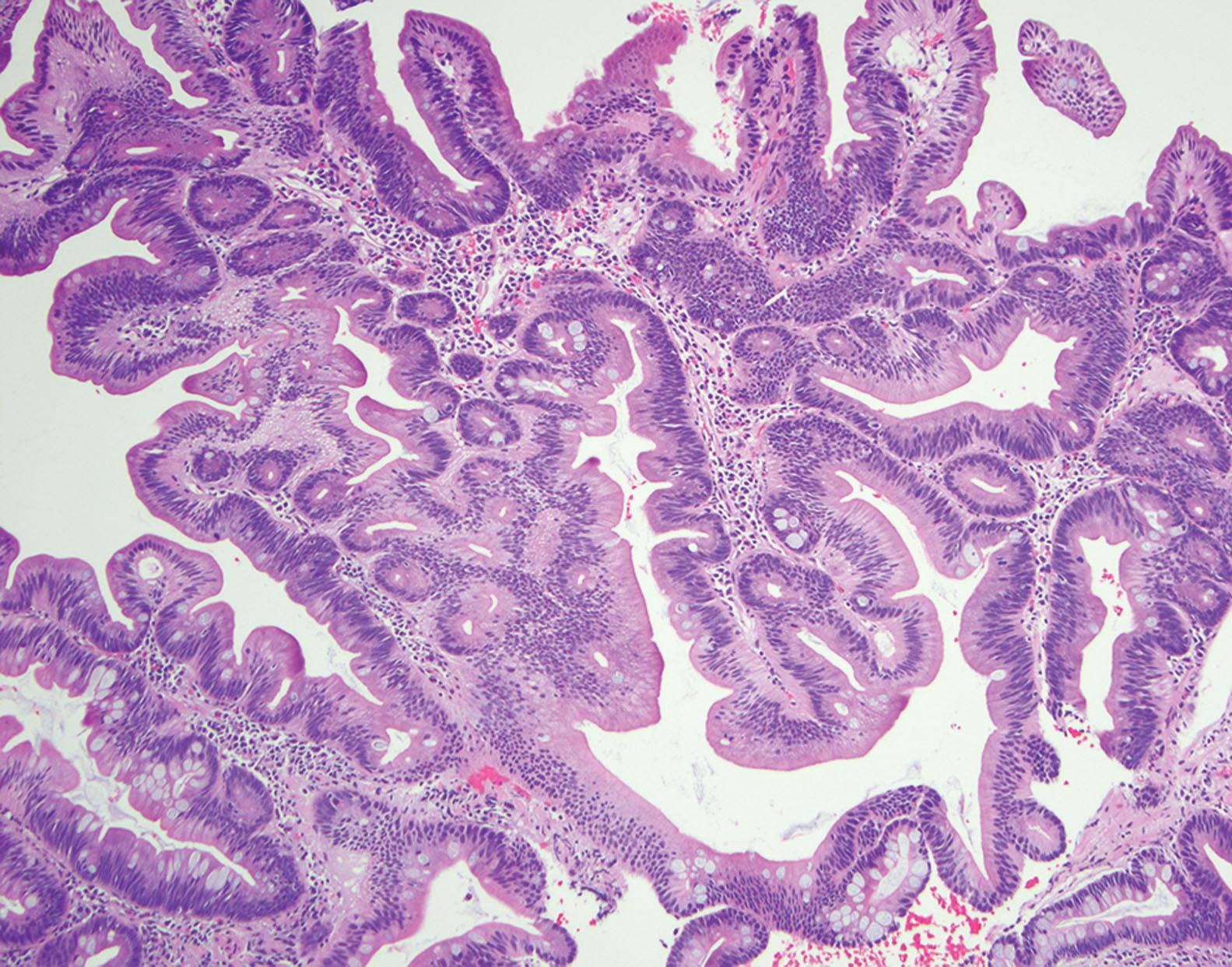 Figure 6.8, Traditional serrated adenoma of the small intestine is rare and poorly defined entity, unlike it's colorectal counterpart