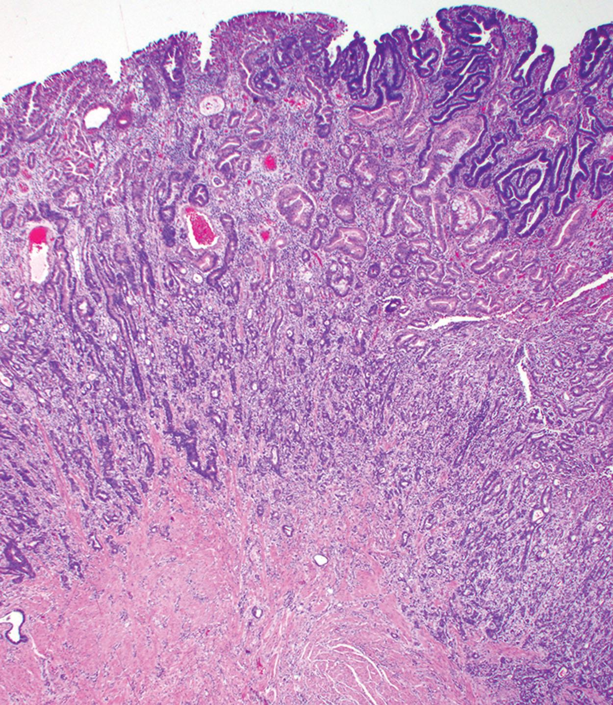 Figure 6.9, Adenocarcinoma of the terminal ileum in the setting of Crohn’s disease. An invasive moderately differentiated adenocarcinoma invades the submucosa and muscularis propria and is present in association wtih dysplasia within the small intestinal mucosa.