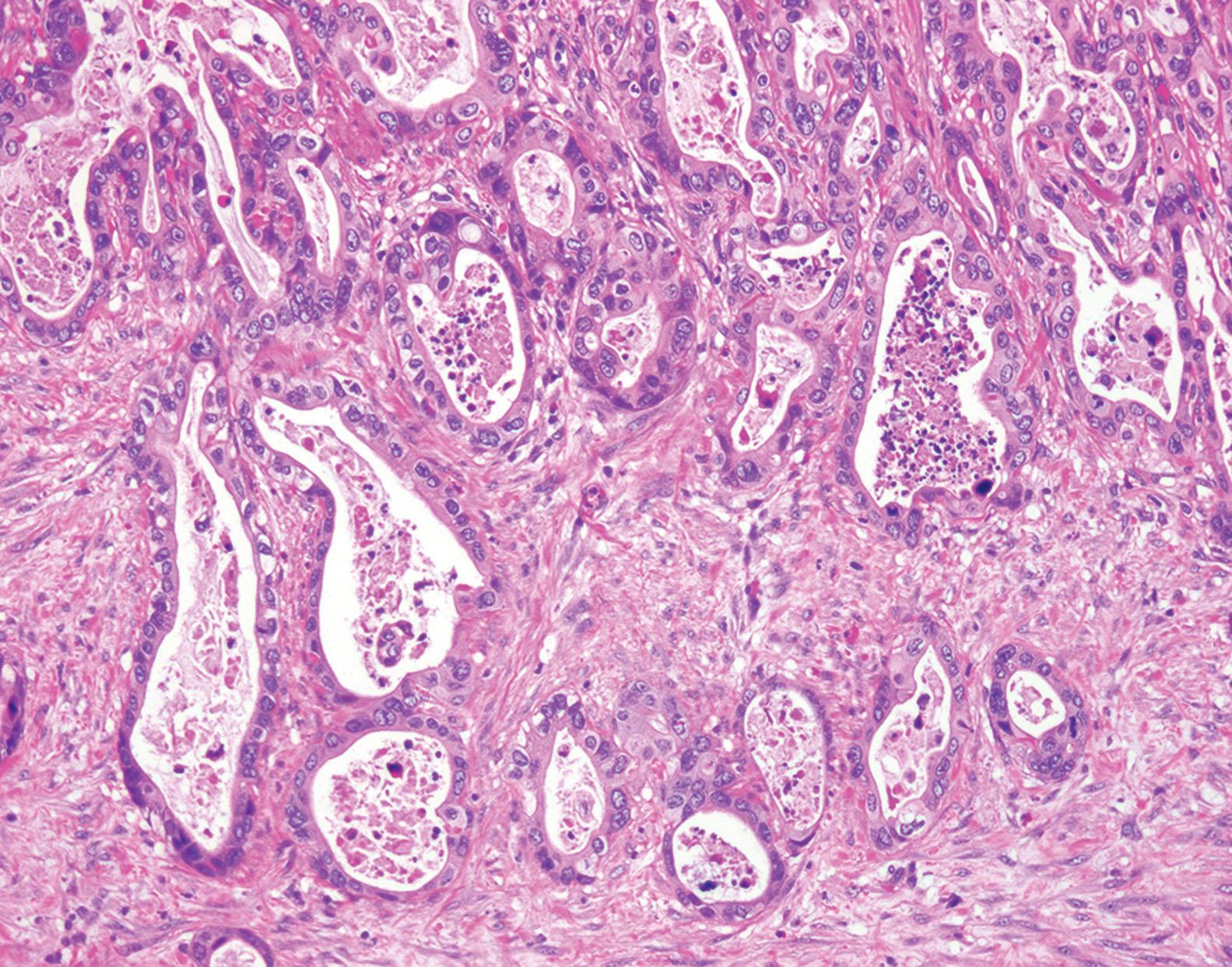 Figure 6.10, Adenocarcinoma of the terminal ileum in the setting of Crohn’s disease. Invasive adenocarcinoma in submucosa characterized by irregular glands, luminal necrosis, and stromal desmoplasia.