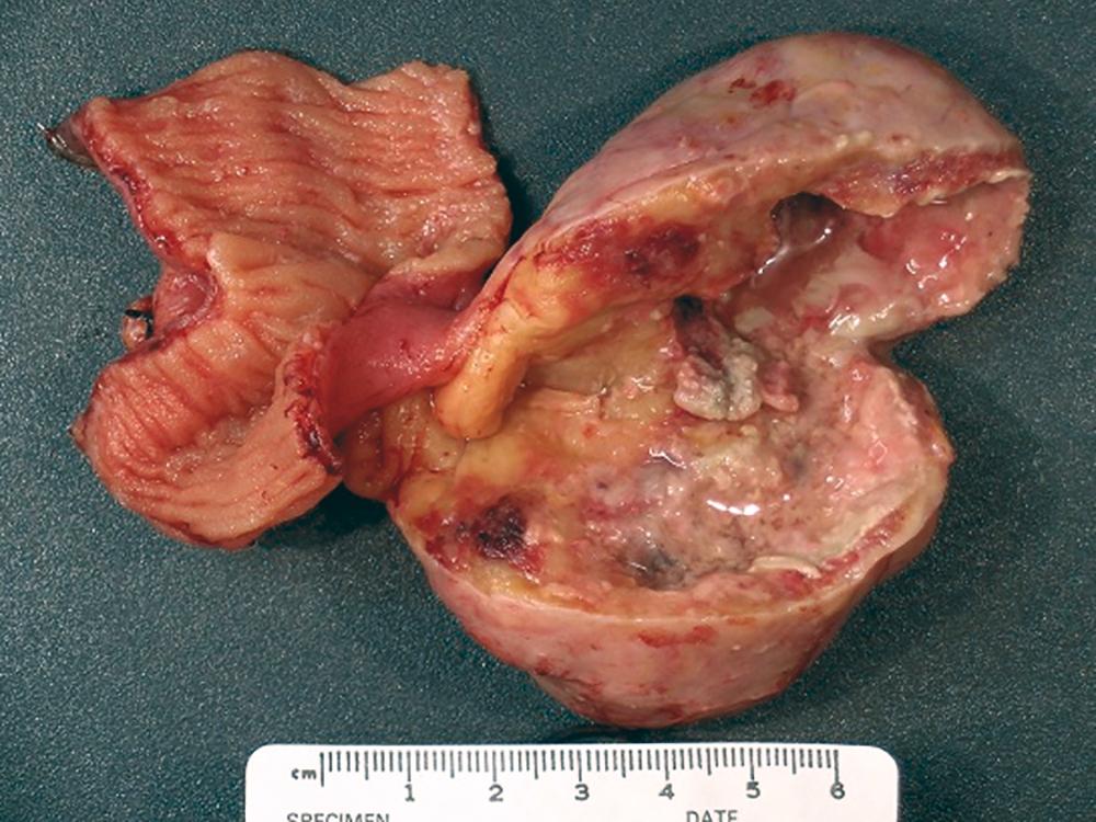 FIGURE 179-1, Small bowel gastrointestinal stromal tumor with ulceration.