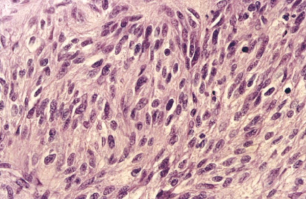 FIGURE 179-2, Histopathology of gastrointestinal stromal tumor (GIST).