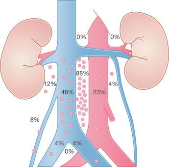 Fig. 13.1, Pattern of early retroperitoneal lymph node involvement from right-sided testicular tumors.