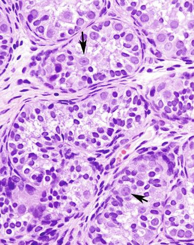 Fig. 13.11, Delayed maturation of germ cells.