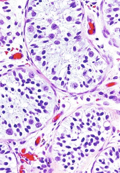 Fig. 13.12, “Pre-GCNIS” gonocyte-like cells occupy both central and basilar loci in the tubules. Simultaneous expression of stem cell factor (KIT-ligand, not shown ) in the same tubule is also required.